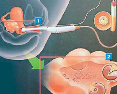 重庆海外试管专业机构(重庆试管婴儿排行榜)